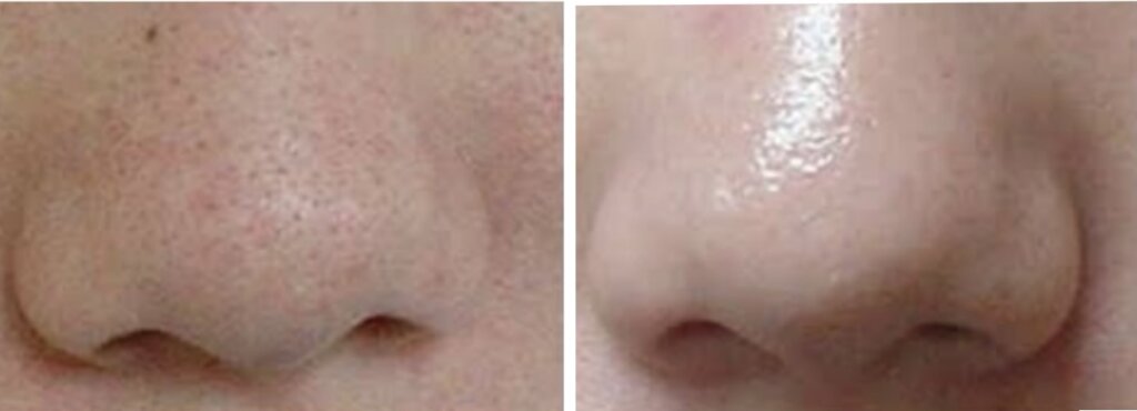 フォトフェイシャル写真