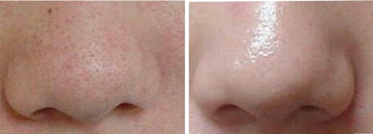 フォトフェイシャル写真