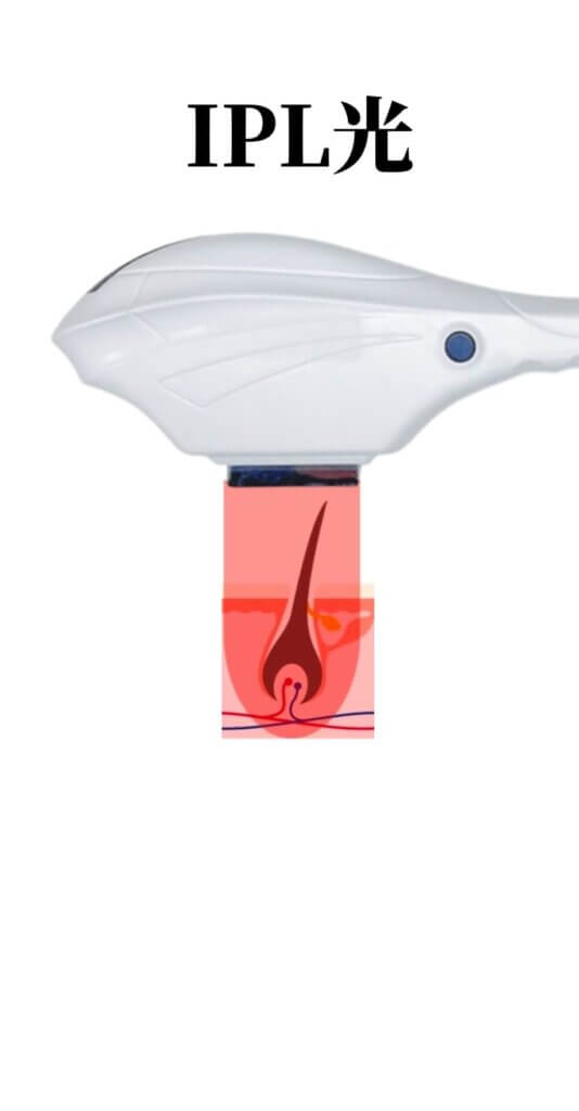 IPL光　絵